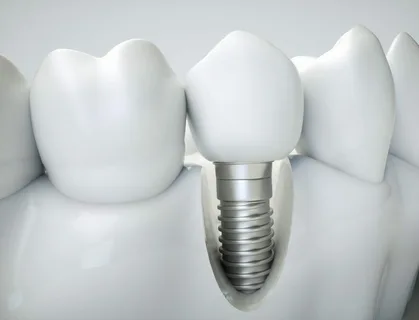 Dental Implants Alexandria
